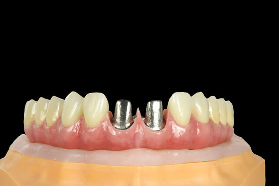 Αγορά FDA Titanium Bridge Οδοντιατρικό εμφύτευμα Titanium Frame με στέμμα online manufacture