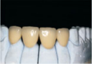 Αγορά Λευκό υψηλό ευγενές πολύτιμο κράμα στέμμα και γέφυρα ακριβής και εξατομικευμένη online manufacture