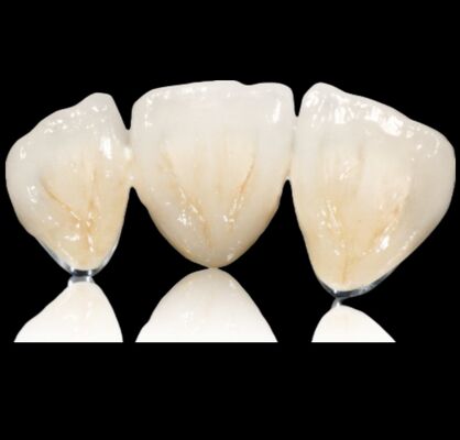 Αγορά Προσαρμόσιμη ημιπολύτιμη κορώνα ή γέφυρα online manufacture