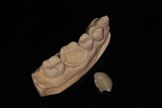 Οδοντιατρική σύνθετη επικάλυψη Onlay High Aesthetics Composite Veneer